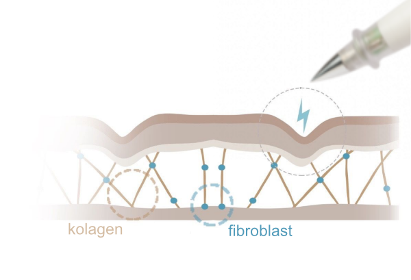 Plazmový výboj prochází bodově, či plošně epidermem (horní vrstva kůže).